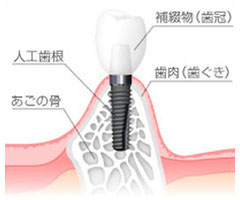 インプラント